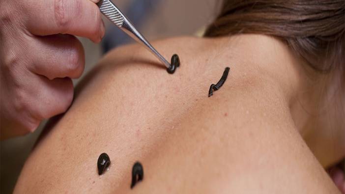 Sülük tedavisi canından ediyordu!