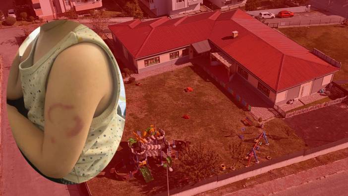 Skandal iddia! Kreşteki öğretmeni tarafından ısırıldı