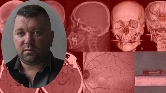 Diş implantı beynine saplandı! Ölümle burun buruna geldi