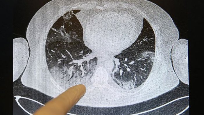 Kovid-19'un akciğerlere verdiği zarar tomografi görüntülerine yansıyor