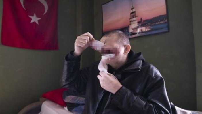 Cilt kanserinden yüzünü kaybeden baba: Kızımı öpmeyi çok özledim