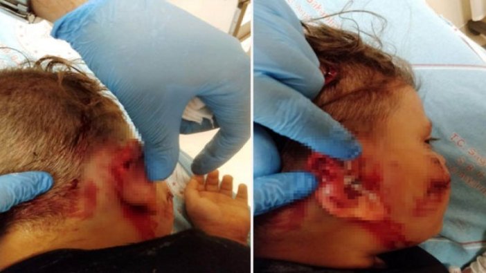 Sevmek istediği köpeğin saldırdığı küçük Yağız ölümden döndü