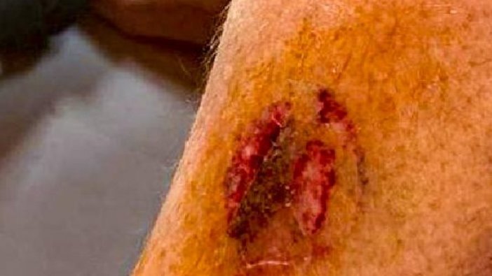 Denize giren kadını caretta ısırdı