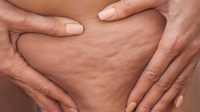 Korkulu rüya: Selülit