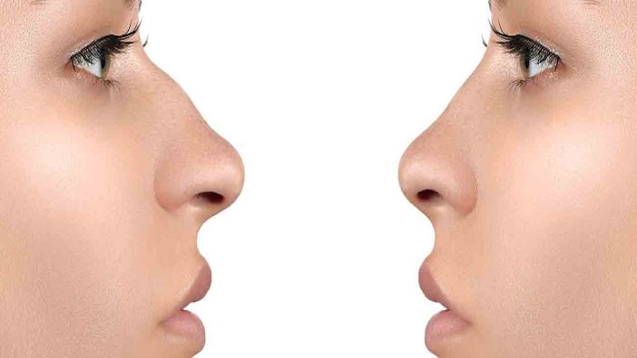 Burun estetiği (rinoplasti) nedir?