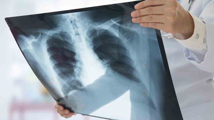 Zatürre aşıları kesinlikle ihmal edilmemeli