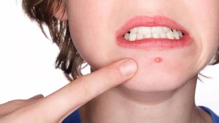 Ergenlik döneminde çıkan akne ve sivilceler için ne yapmalı?