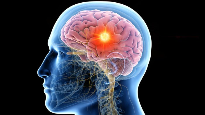 Bu tümör çok yaygın görülüyor: 3 yeni alt türü bulundu