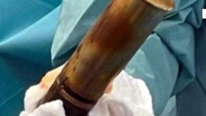 Anüsüne top mermisi sıkıştı, hastane boşaltıldı