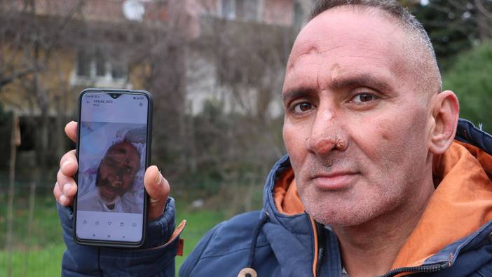 Afrika sineğinin ısırdığı adam tanınmayacak hale geldi!