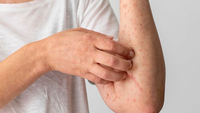 Besin alerjisi nedir? Nasıl anlaşılır?