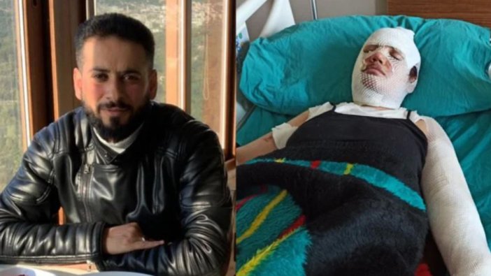 Erkek şiddeti deprem dinlemiyor! Eski eşini kaynar suyla haşladı