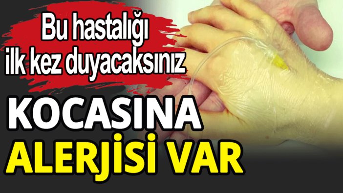 Kadının kocasına karşı alerjisi var