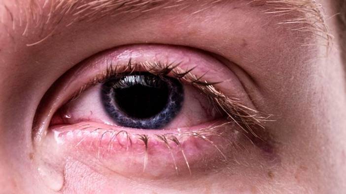 Alerjisi olanlar dikkat: Uzman isimden kritik göz uyarısı!