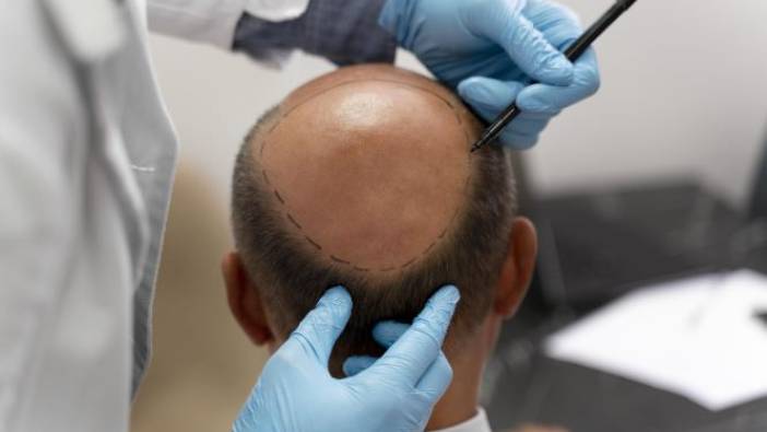 Saç ektirecekler bu detaylara dikkat