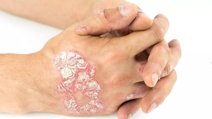 'Sedef' artık tedavisi olan bir hastalık