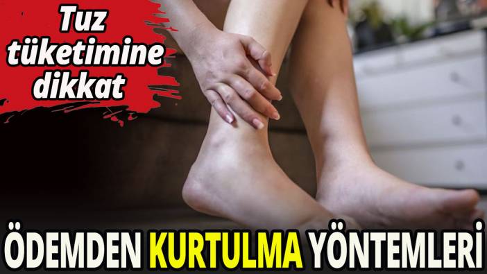 Ödemden kurtulma yöntemleri