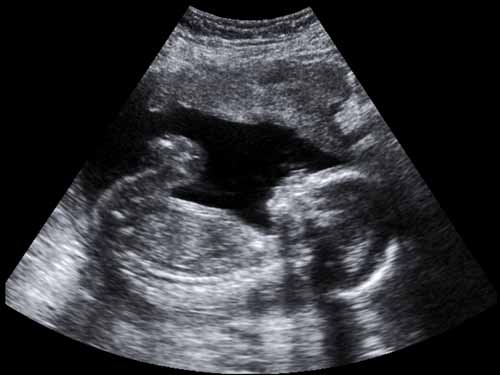 gebelik-ultrason.jpg